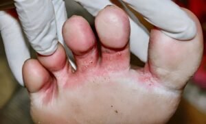 Effective Home Remedies for Athlete's Feet or Tinea Pedis Infection
