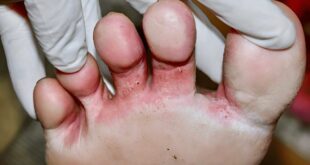 Effective Home Remedies for Athlete's Feet or Tinea Pedis Infection