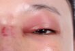 Eye swelling remove with cold process