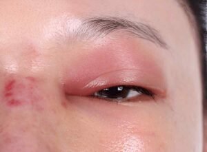 Eye swelling remove with cold process