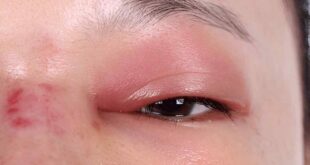 Eye swelling remove with cold process