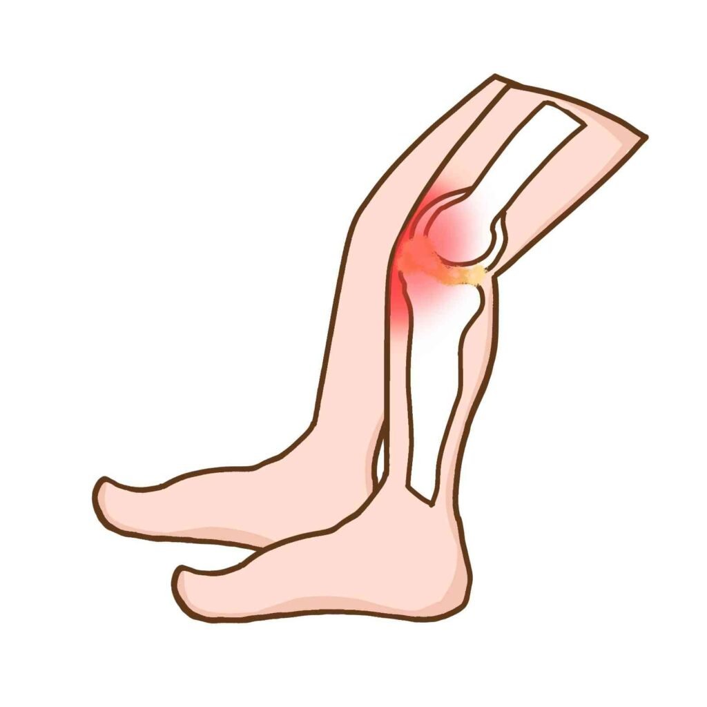 Inflammation