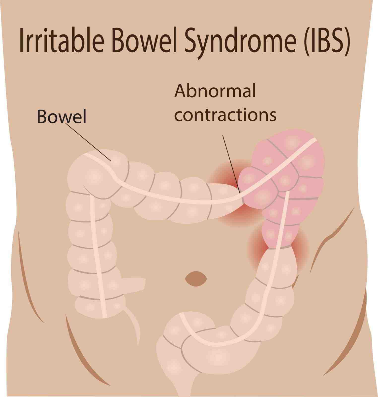 Irritable Bowel Syndrome