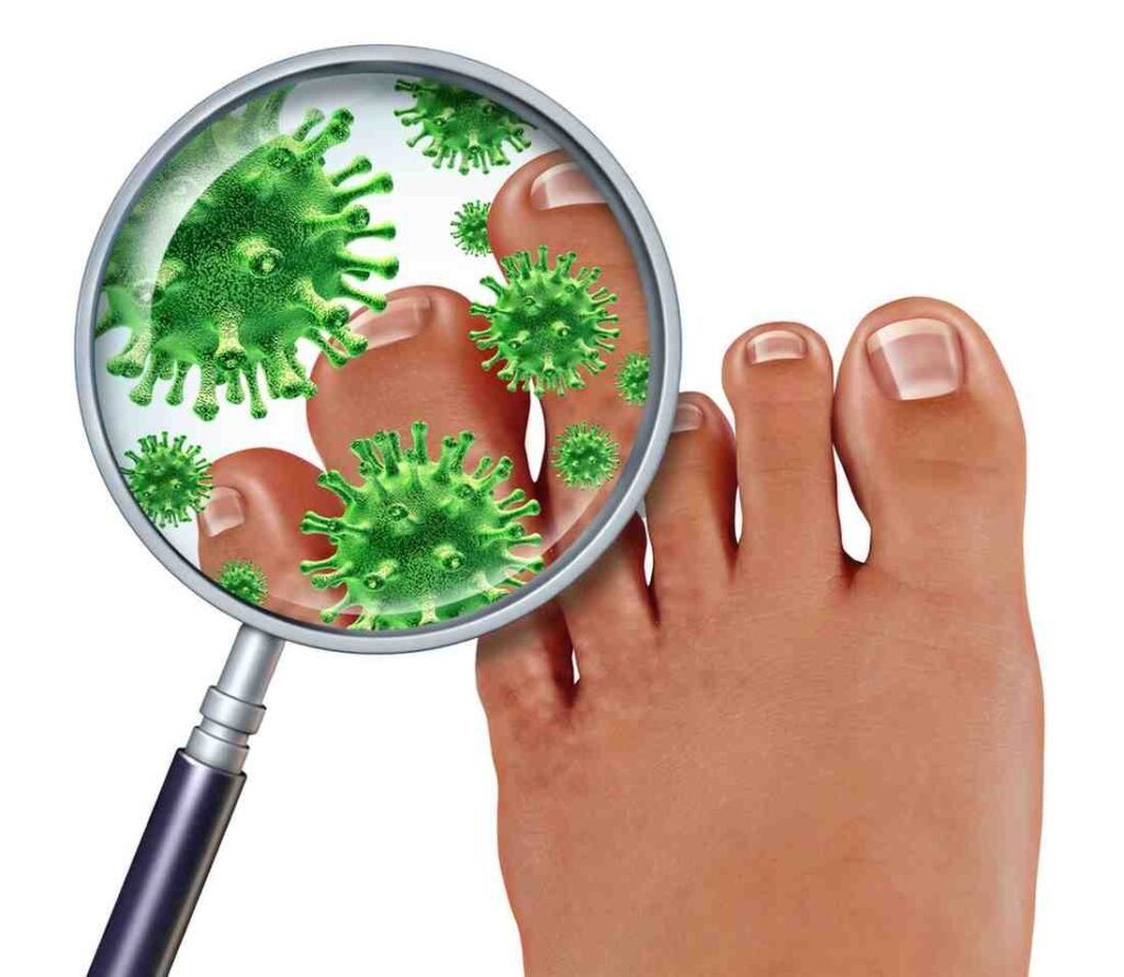Nail Fungus