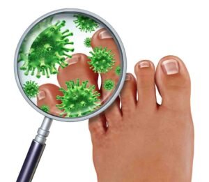 Nail Fungus