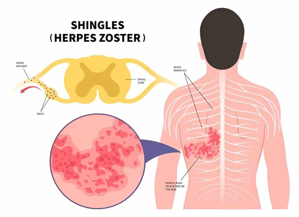 Natural Home Remedies for Shingles