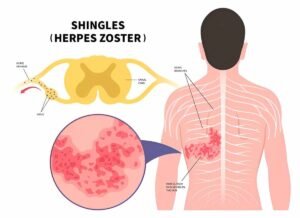 Natural Home Remedies for Shingles