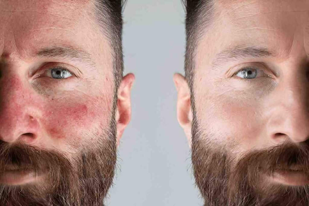 Natural treatment of Rosacea