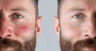 Natural treatment of Rosacea