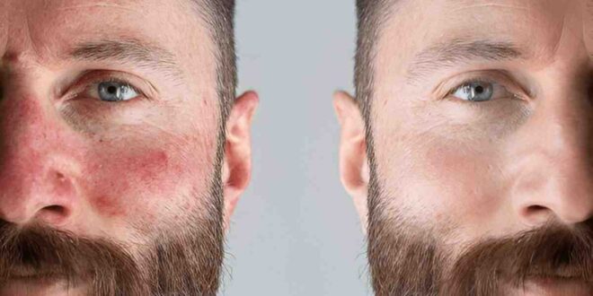 Natural treatment of Rosacea