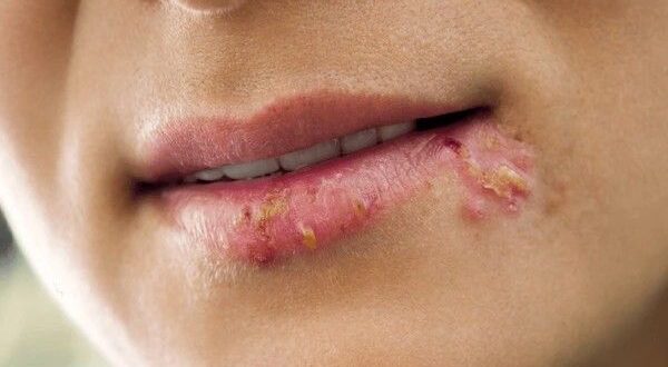 cold sore on lip