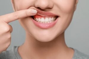 gingivitis