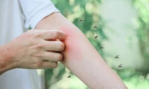 mosquito bites
