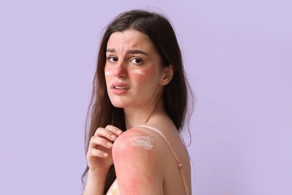 sunburn skin
