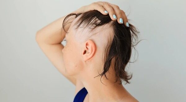 Alopecia