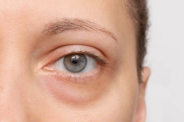 Bags Under Eyes