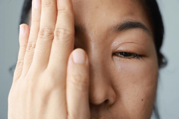 Swollen Eyes from Allergies