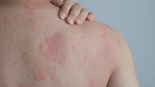allergic reaction