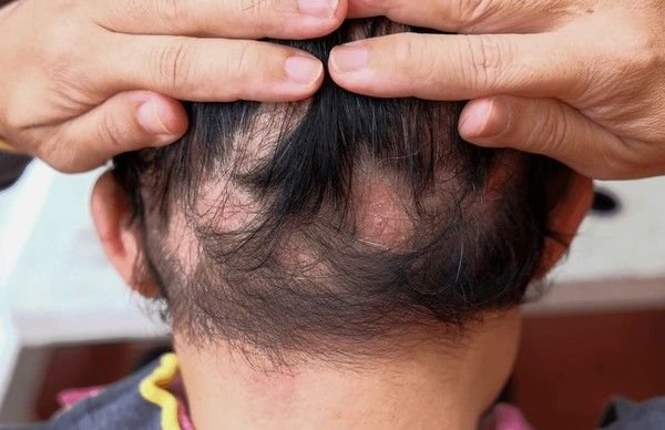alopecia areata
