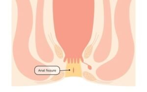 anal fissure