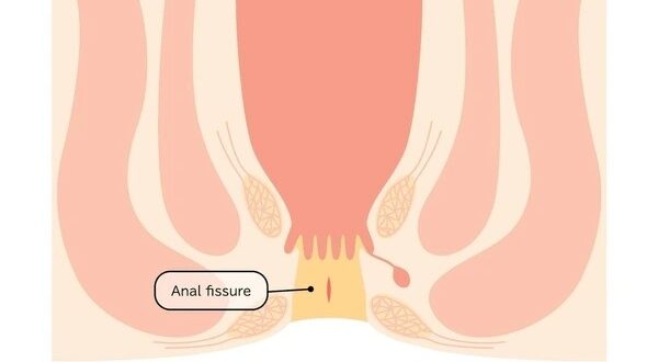 anal fissure