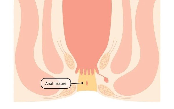 anal fissure