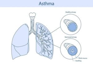 asthma