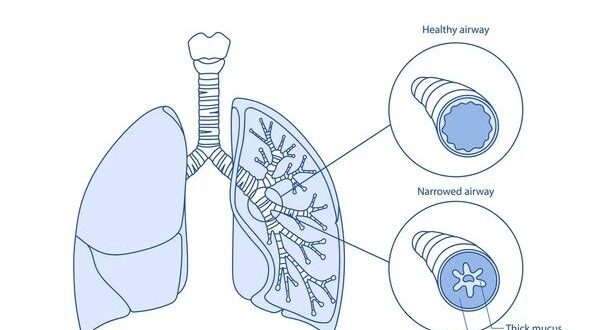 asthma