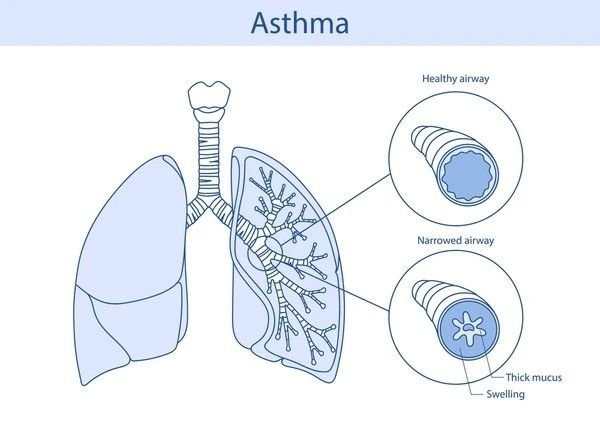 asthma