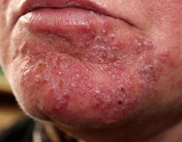 bacterial infection