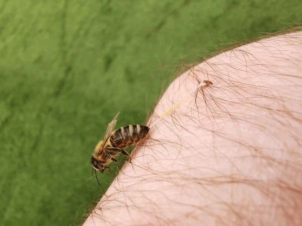 bee stings