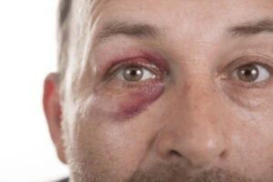 black eye