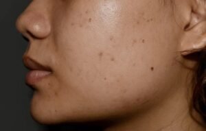 black spots on face