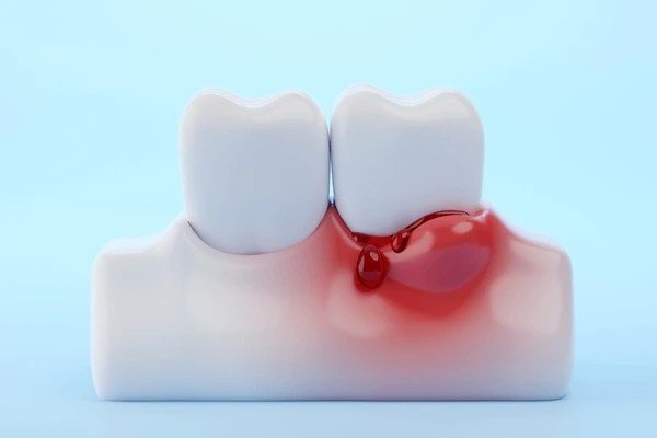 bleeding gums