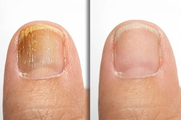 brittle nails