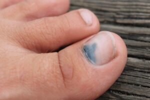 bruised toenails