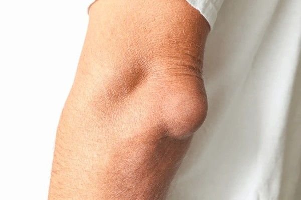 bursitis