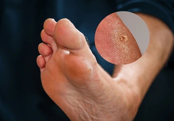 calluses on feet