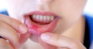 canker sores