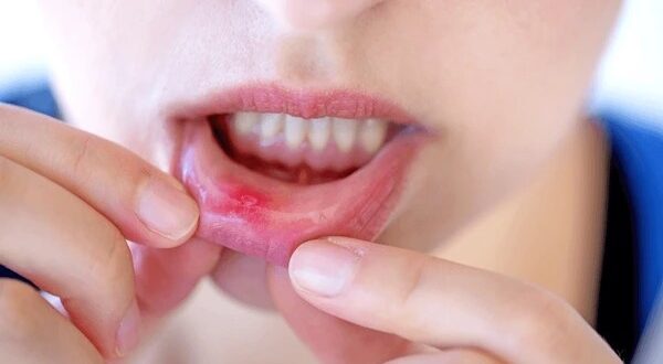 canker sores