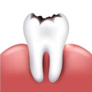 cavities