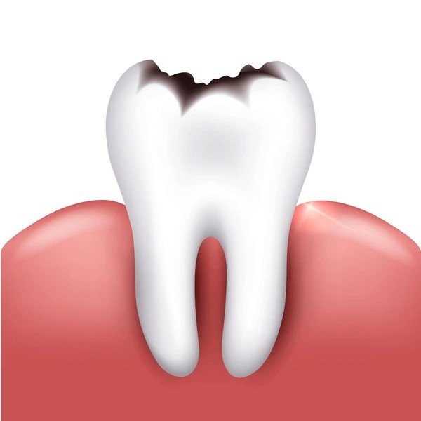 cavities