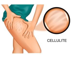 cellulite