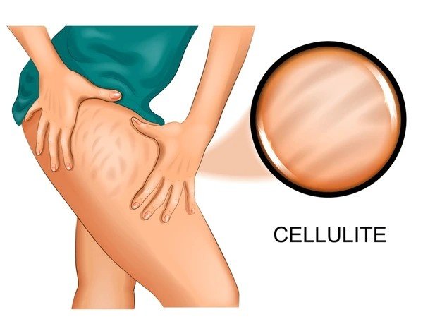 cellulite
