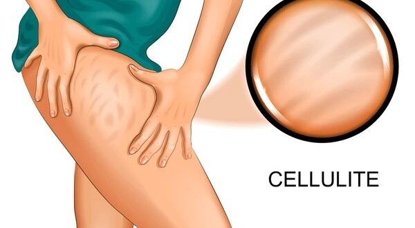 cellulitis