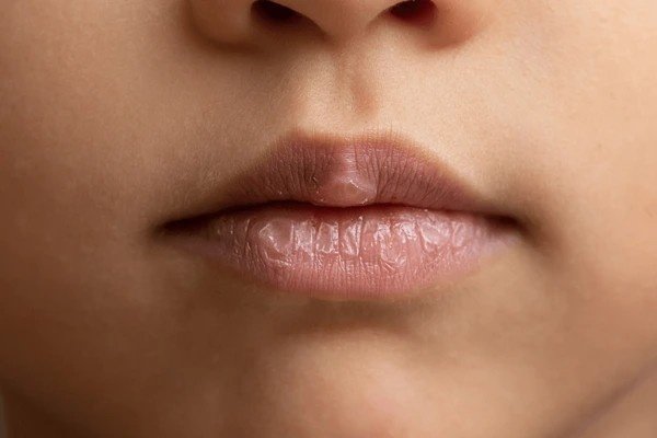 chapped lips