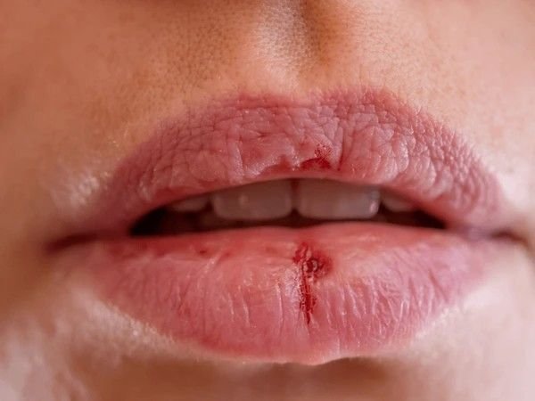 chapped lips