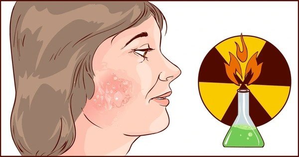 chemical burn on face