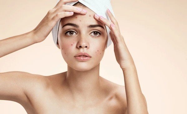 chicken pox spots removal