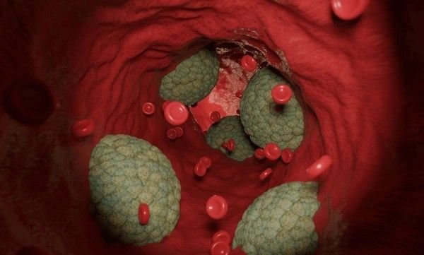 cholesterol deposits